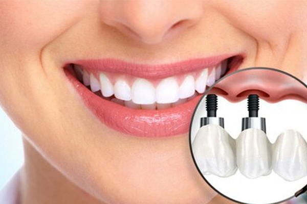 İmplant Sonrası Bakım